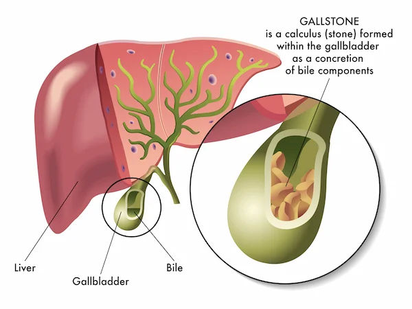 Gallstones: Symptoms, Causes and Treatment